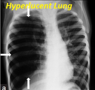 hyperlucent-lung