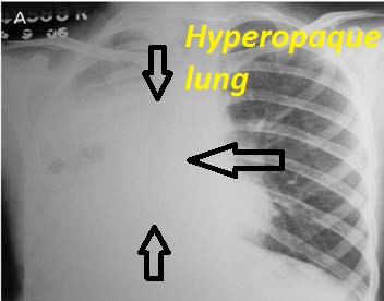 hyperopaque-lung