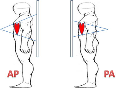 AP-vs-PA-view-of-Chest-Xray