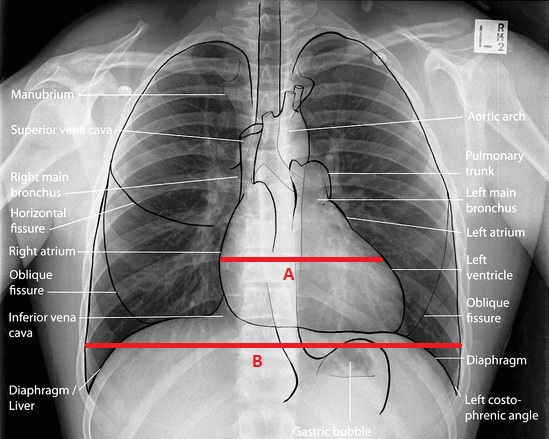 Basics Of Reading Chest X Ray Simply Explained Medicos Times