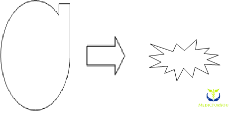 Collapse-of-lung