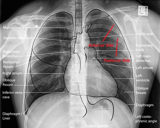 Counting-ribs-CXR