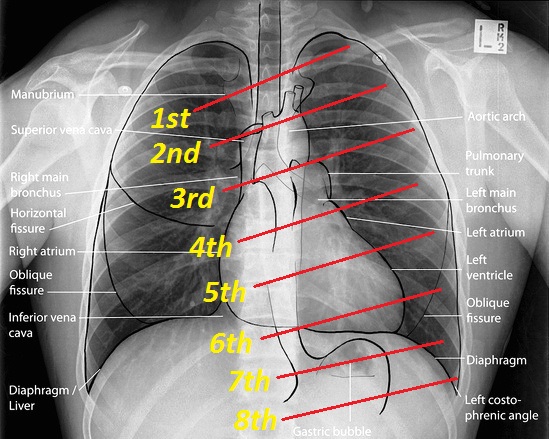 Counting-ribs-chest-xray