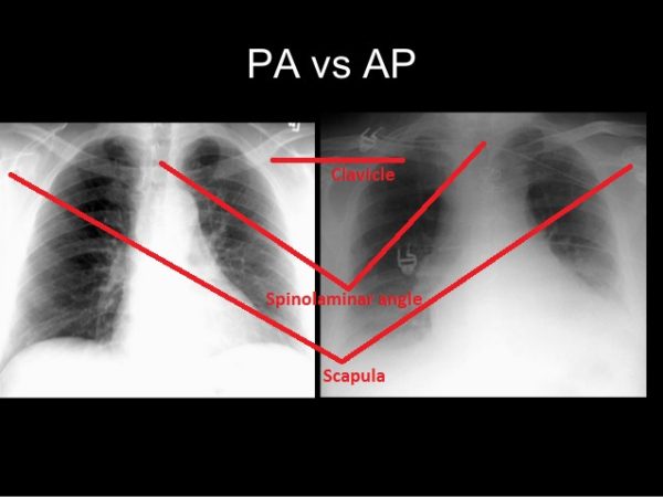 Understanding Basics of Reading Chest X-ray [Simply Explained ...