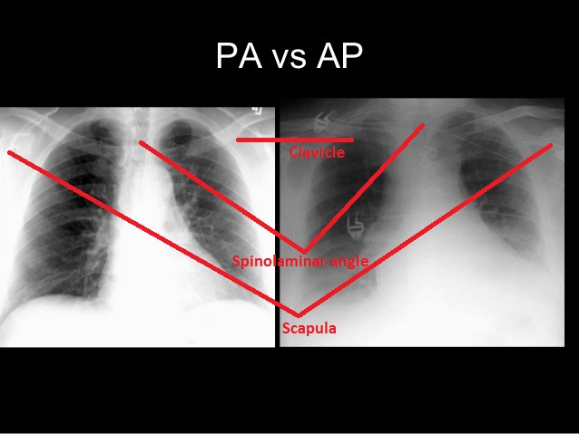 PA-vs-AP-view-Chest-Xray