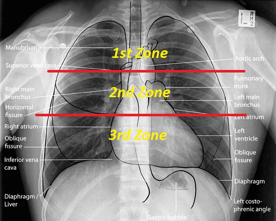 Zones-in-Chest-x-ray