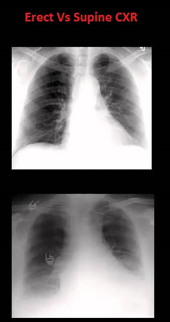 erect-vs-supine-cxr