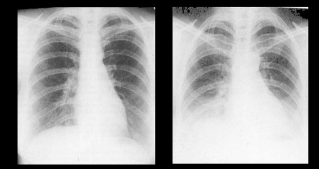 inspiratory-vs-expiratory-chest-xray